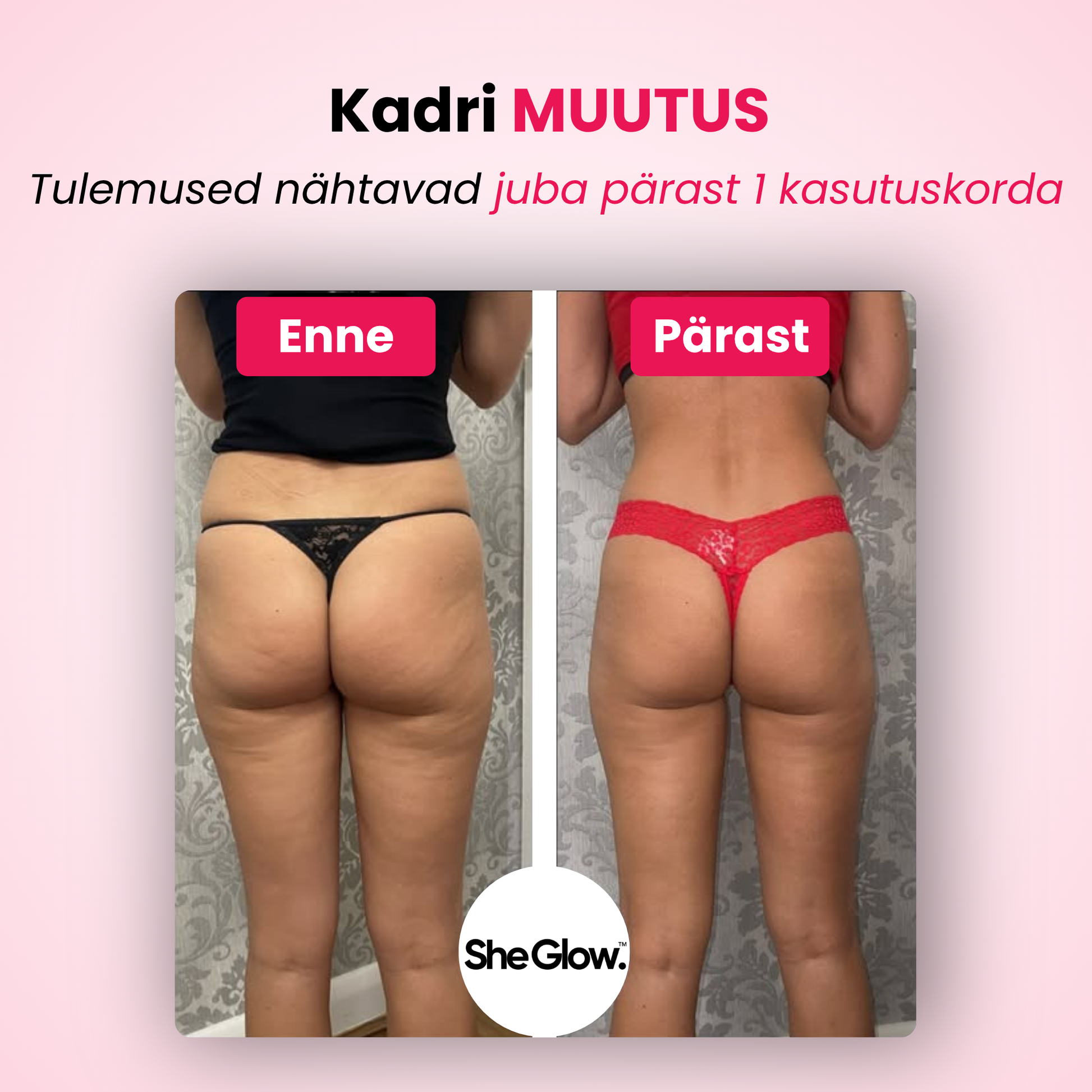 SheGlow tselluliidivastase seadme tulemused – enne ja pärast fotod, nähtavad tulemused juba pärast esimest kasutuskorda